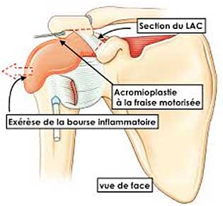 lésions de l'épaule rochefort charente maritime 17