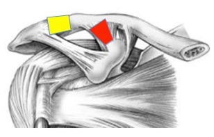 entorse claviculaire