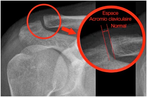 entorse claviculaire