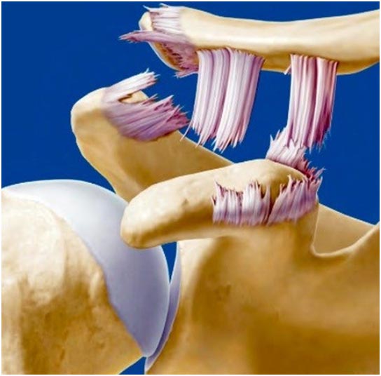 entorse claviculaire