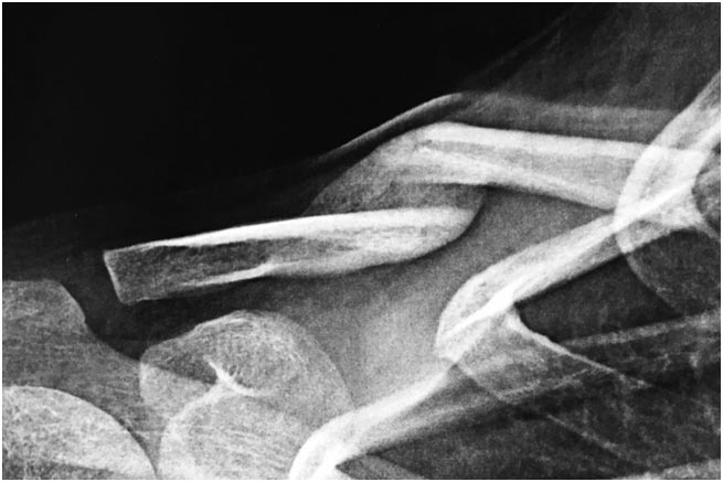 fracture de l'épaule