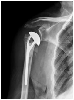 Prothèse anatomique céphalique pour fracture