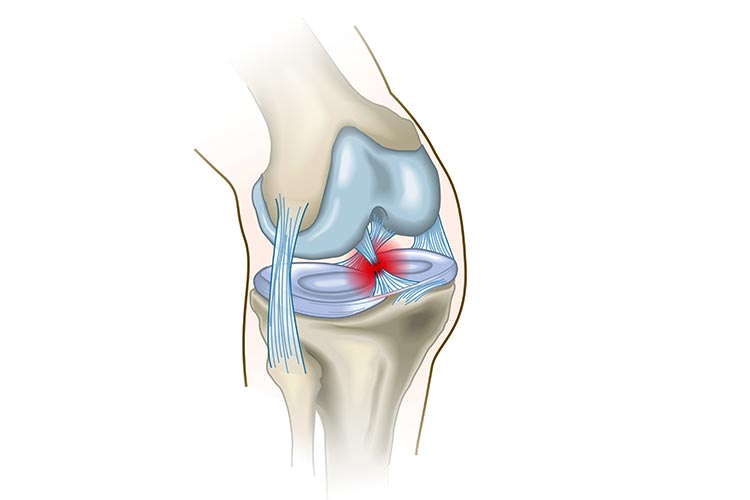 reconstruction du ligament croisé antérieur chirurgie conservatrice du genou centre chirugical orthopédie Rochefort  Charente Maritime