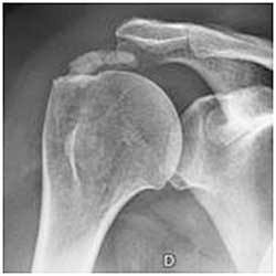 tendinopathie calcifiante de l'épaule rochefort charente maritime 17